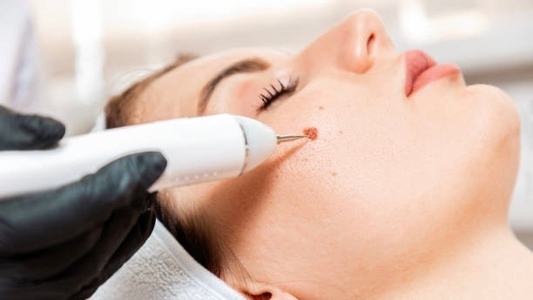 Skin Tag Removal Course
